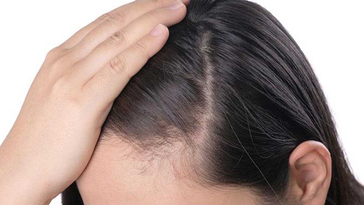 روش‌ های پیشگیری از ریزش مو زنانه