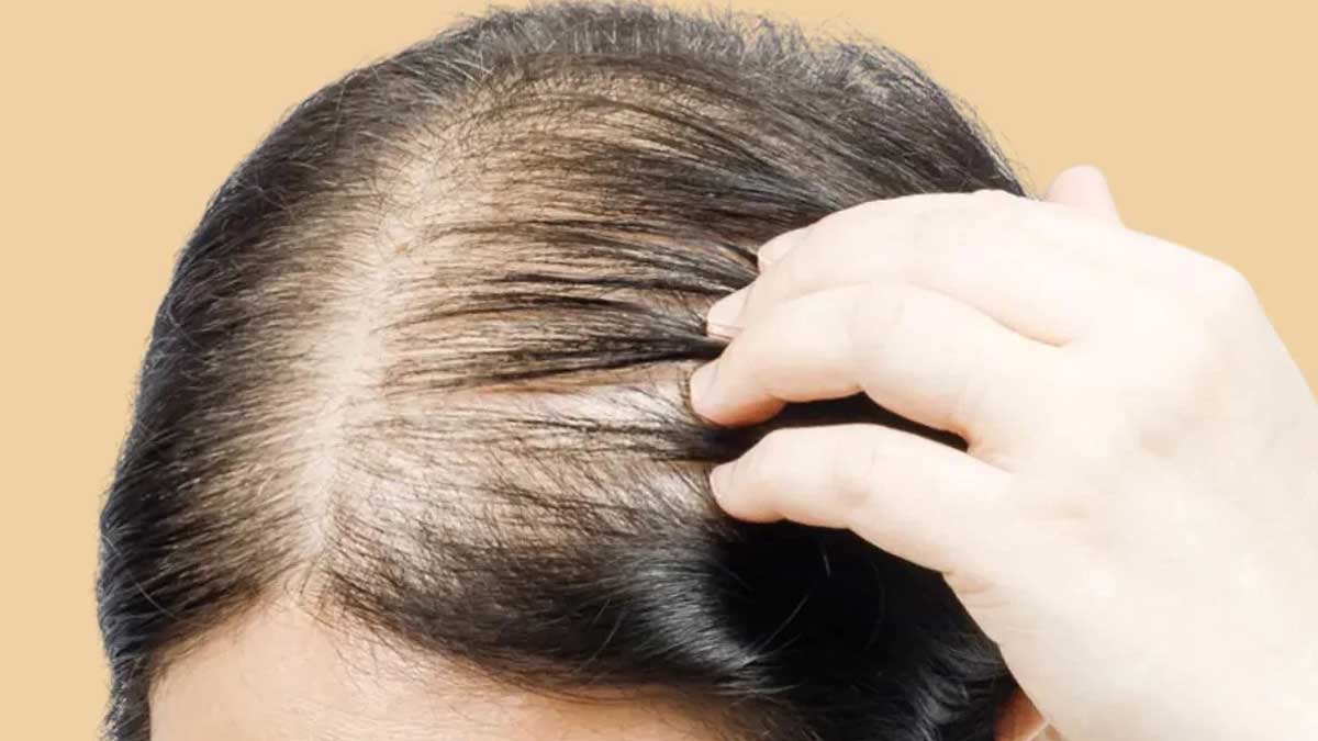 علائم ریزش مو خطی
